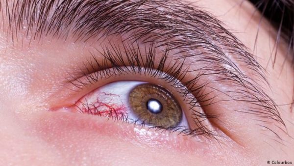 ما هو التهاب العين الفيروس؟