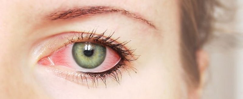 علاج التهاب العين الفيروسي