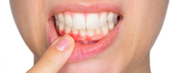لماذا يحدث ألم بالأسنان واللثة؟