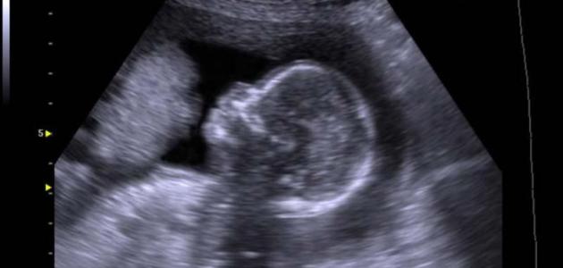 هل الحمل خارج الرحم يظهر بالسونار ؟