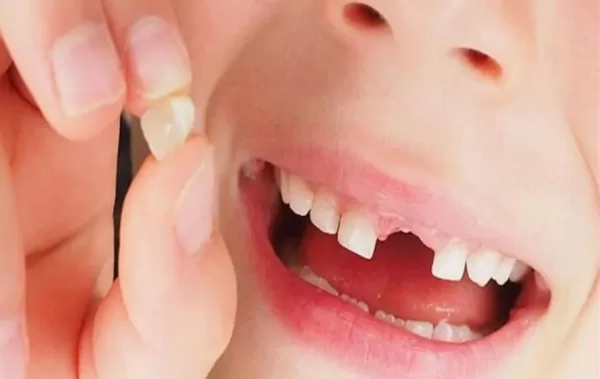تفسير حلم سقوط الأسنان الأمامية العلوية في منام العزباء